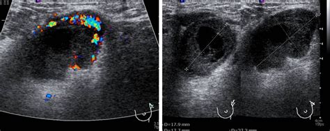 Invasive Breast Carcinoma Of No Special Type Radiology Cases