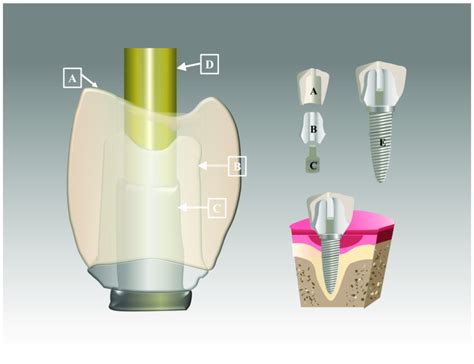 Schematic diagram showing design of abutment and crown: A-crown;... | Download Scientific Diagram