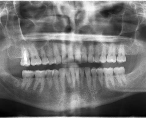 Ankylosis of the deciduous tooth: diagnosis and possible treatments