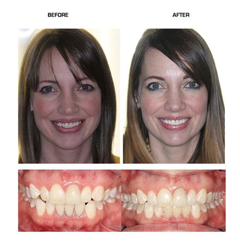 Invisalign Before And After Overjet