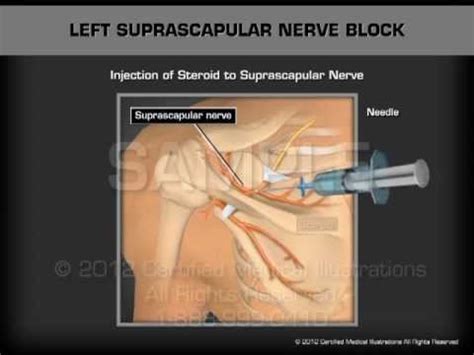 Left Suprascapular Nerve Block Youtube