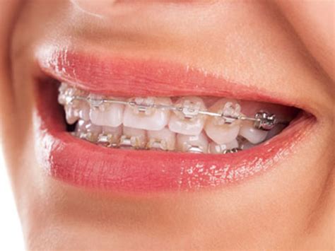 Invisalign Vs Ceramic Braces