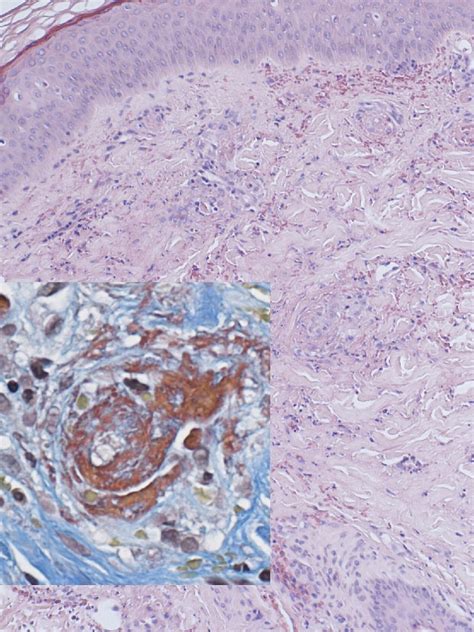 Anca Associated Renal Vasculitis Following Antitumor Necrosis Factor α