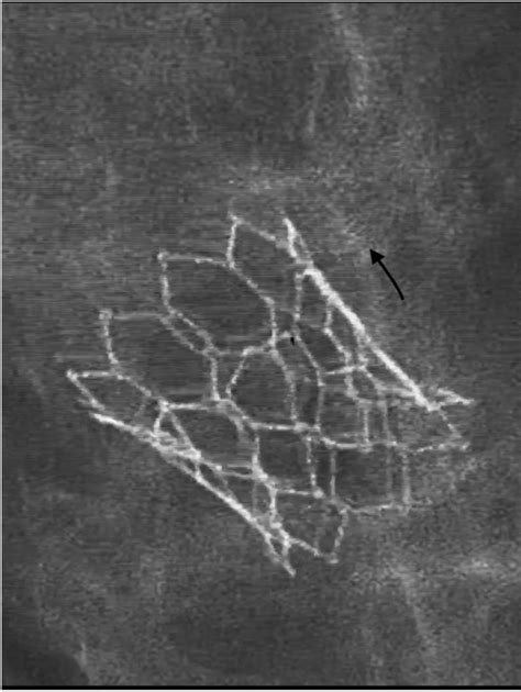 TAVI Device And The Overlapping Distal Segments Of Stents Visible