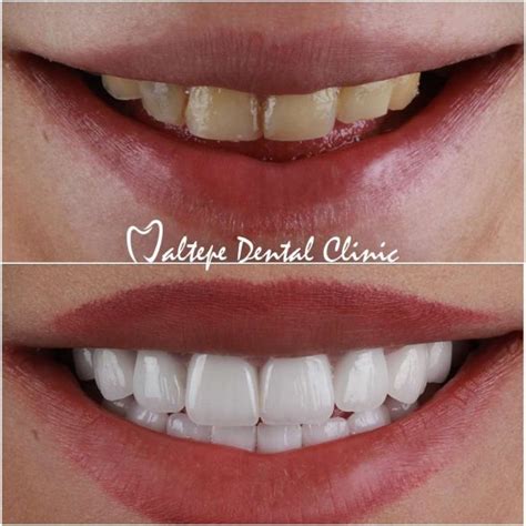 Hollywood Smile Everything You Want To Know About Maltepe Dental Clinic