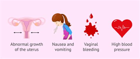 Molar Pregnancy Or Hydatidiform Mole Types Symptoms And Diagnosis