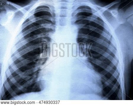 Close- Chest X-ray. Image & Photo (Free Trial) | Bigstock