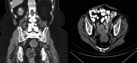 Computed Tomography Scan Showing Well Circumscribed Perirectal Lesion