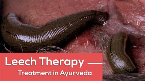 Leech Therapy