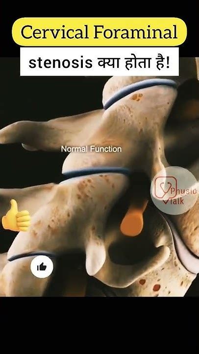 Cervical Foraminal Stenosis Shorts Cervicalpain Cervicalforaminalstenosis Youtube