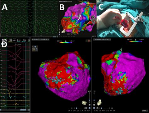 Electrophysiological Study And Mapping Data In Case 1 A During