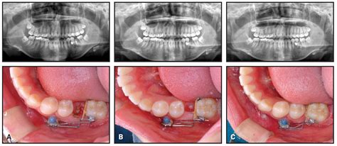 Benefits of Delaying Root Extraction to Accelerate Space Closure