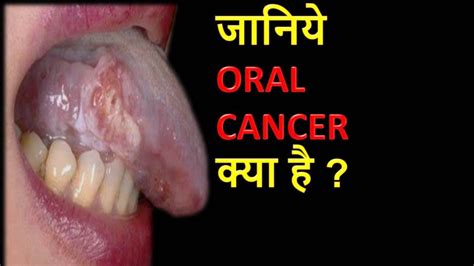 When To Get Tested For Mouth Cancer HINDI मह क कसर क लकषण