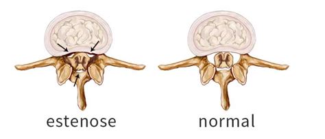 Estenose Cervical O Que Causas Sintomas E Tratamento Viva Fisio