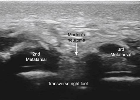 Superficial Peroneal Nerve Block At The Ankle Clinical Tree