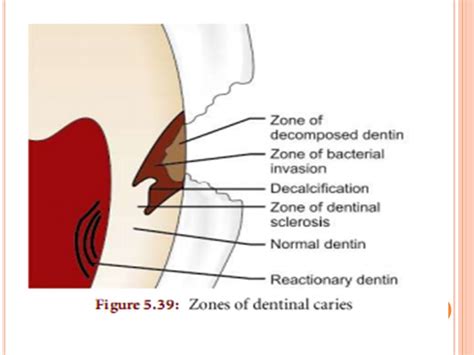 Histopathology Of Caries In Enamel And Dentine Dentalnotebook