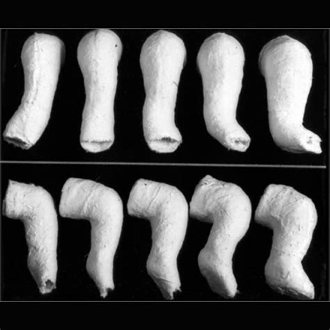 How The Ponseti Method Works Ponseti Clubfoot