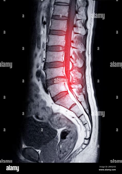 Mri L S Spine Or Lumbar Spine Sagittall T1w View For Diagnosis Spinal