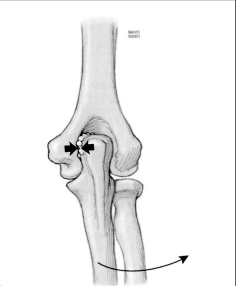 Illustration Depicting Posteromedial Olecranon Impingement And