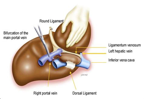 Caudate Lobectomy Tumor Location Topographic Classification And