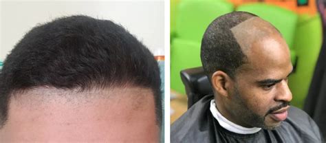 How To Fix Your Hairline 9 Ways To Get It Back On Track