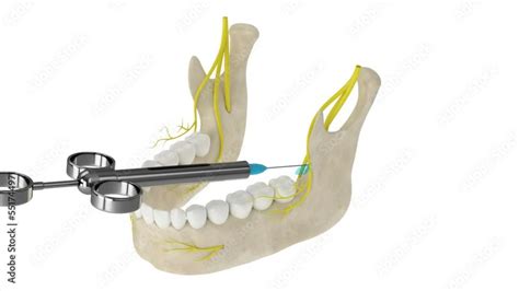 Mandibular Arch With Buccal Nerve Block Types Of Dental Anesthesia