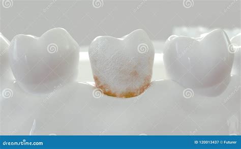 Strong Plaque On A Molar Tooth 3d Rendering Stock Illustration