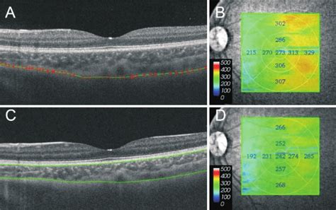 Swept Source Optical Coherence Tomography Images Showing The Choroidal