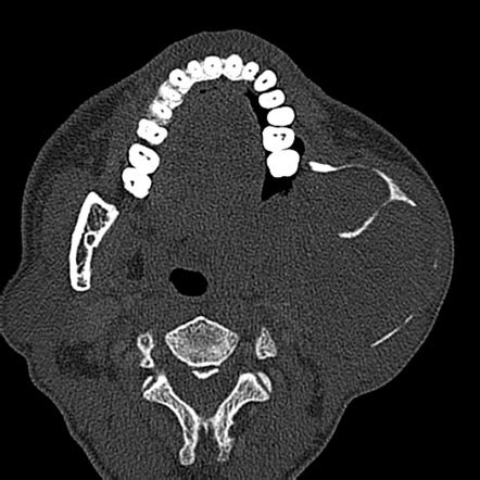 Ameloblastoma Radiology Case Radiopaedia Org