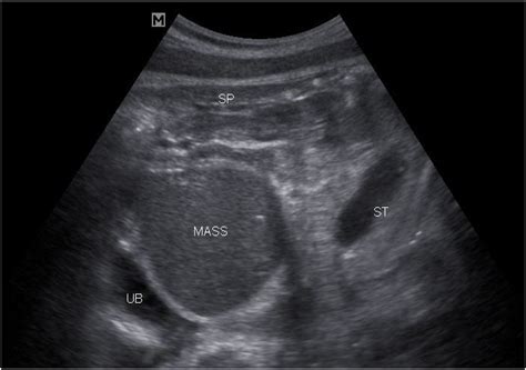 Antenatal Ultrasound Diagnosis Of Huge Fetal Hydrometrocolpos Secondary