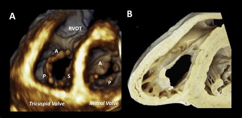 Atrial View Of The Tv And Mv Leaflets By Transthoracic 3de A Compared Download Scientific