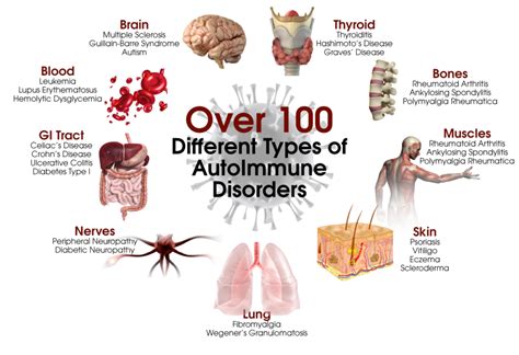 Functional Medicine Approach to Autoimmune Disease | UltraWellness