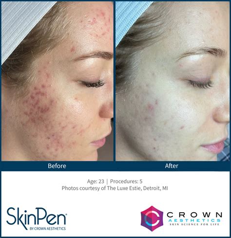 Skinpen Microneedling Aspen Aesthetics