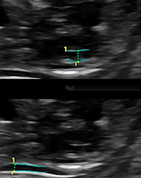 Sono IT NT Measurement First Trimester Voluson Ultrasound