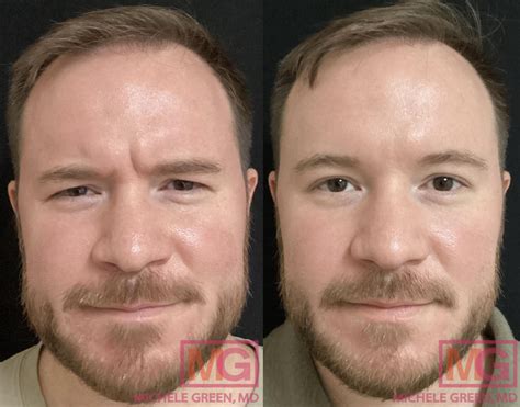 Botox Before And After Men