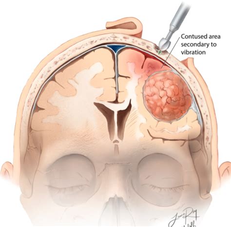 Neuro Head Trauma Icp Brain Neoplasm Flashcards Quizlet