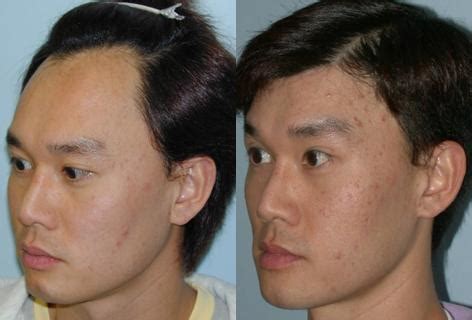 Forehead Reduction | San Francisco, CA