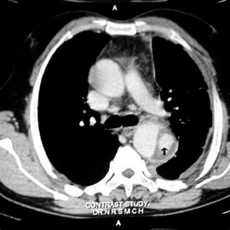 Dissecting Aneurysm Of Descending Aorta With False Lumen Black Arrow