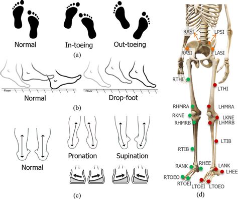 Gait Abnormalities