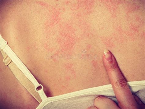 Woman Scratching Her Itchy Back with Allergy Rash Stock Image - Image ...