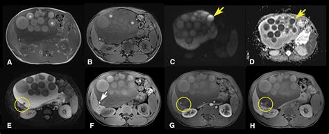 Mature Cystic Teratoma Airp Best Cases In Radiologic Pathologic Correlation Radiographics