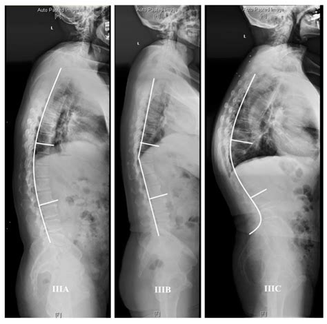 Thoracolumbar/Lumbar Degenerative Kyphosis—The Importance of