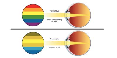 penyakit buta warna total  buta warna parsial deherbacom