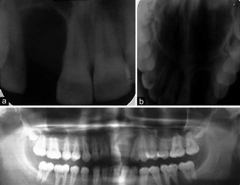 A Iopa Revealing Pear Shaped Well Defined Radiolucency Between