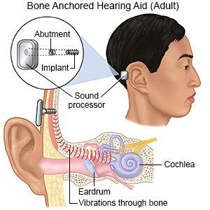 Bone Anchored Hearing Aid Surgery - What You Need to Know