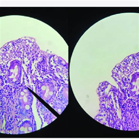 Histological findings in duodenal biopsy. | Download Scientific Diagram