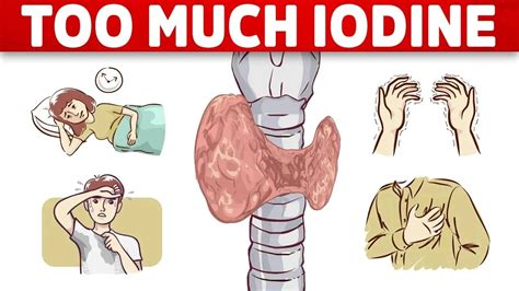 The 1 Sign Of Iodine Overload TOXICITY