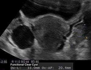 Ovarian Cysts Anthony Siow