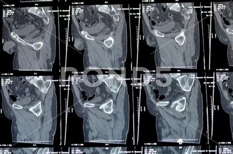 Cairo Egypt November Non Enhanced Ct Scan Of The Pelvis