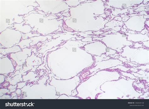 Diffuse Lung Emphysema Light Micrograph Photo Stock Photo